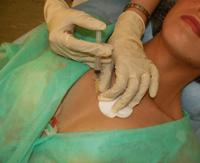 Einbringen eines Meso-Cocktails in das Brustgewebe – eine Alternative zu Hyaluronsäure-Injektionen