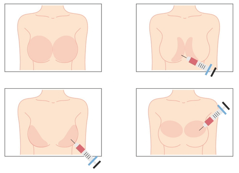 Stellen zur Injektion von Hyaluronsäure in die Brust