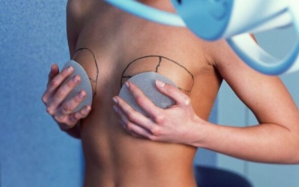 Brustvergrößerung mit Implantaten