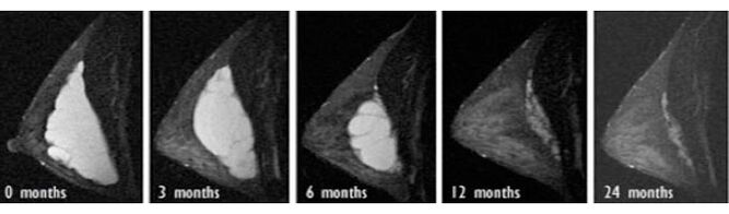 Der Prozess der Resorption von Hyaluronsäure in der Brust